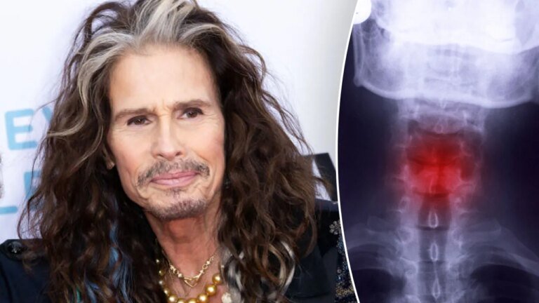 Steven Tyler’s career-ending throat injury: What is a fractured larynx?