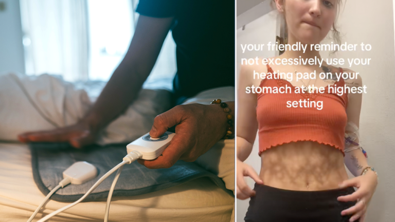 What is ‘toasted skin syndrome’? Experts warn heating pads can cause skin damage