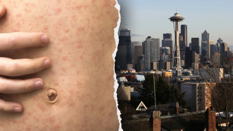 Measles exposure alert at Seattle airport after Canadian traveler visits Washington state