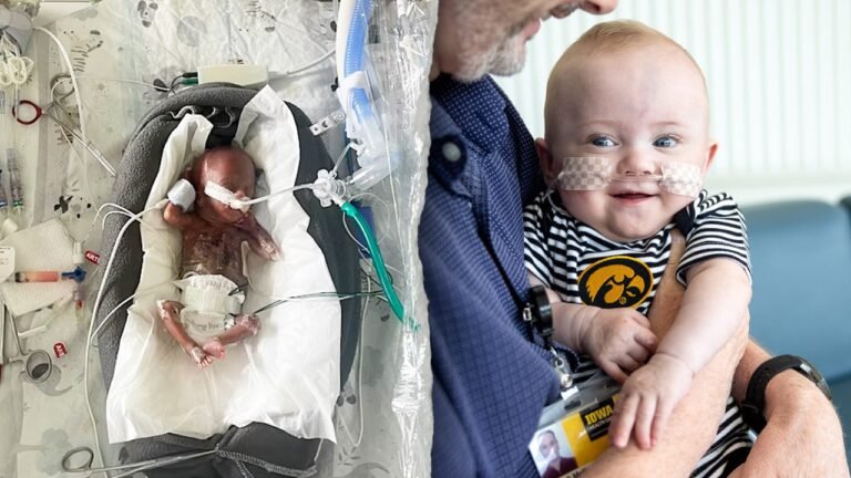 Iowa baby, born at 21 weeks, holds world record as the most premature