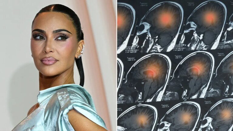 Doctors sound alarm after Kim Kardashian’s brain aneurysm revelation