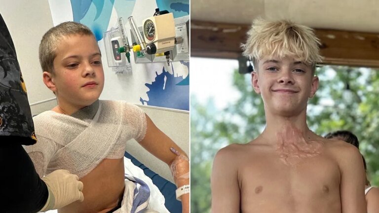 Viral NeeDoh microwave trend leaves teen with third-degree burns